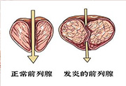 前列腺疾病